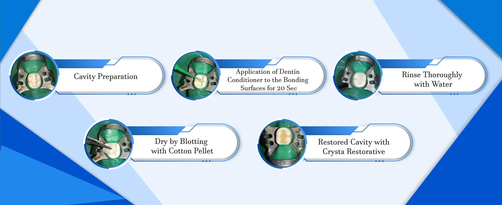 dentin conditioner