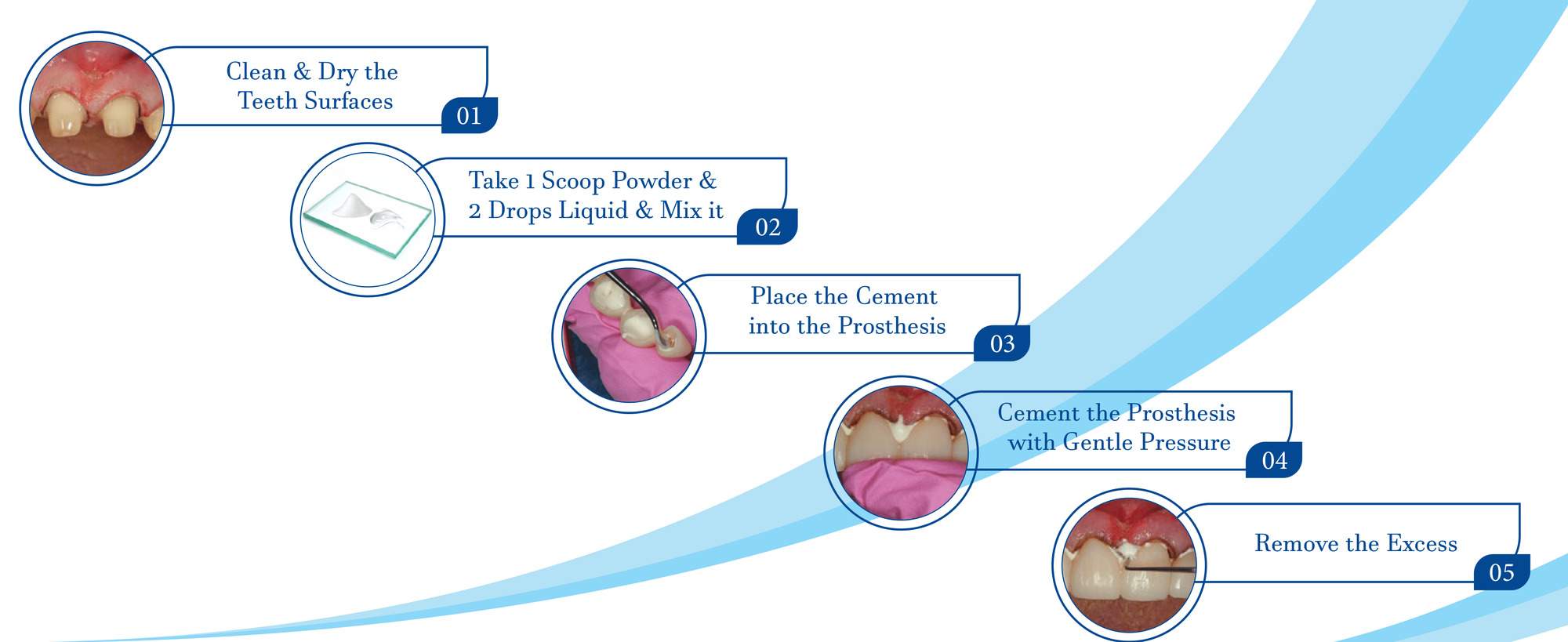 type 2 luting glass ionomer cement