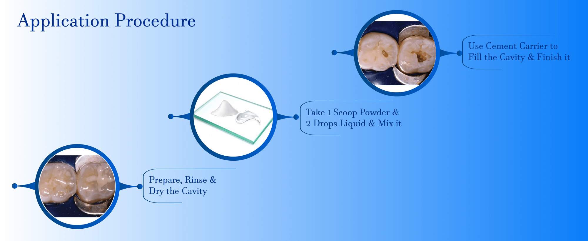 type 2 restorative glass ionomer cement