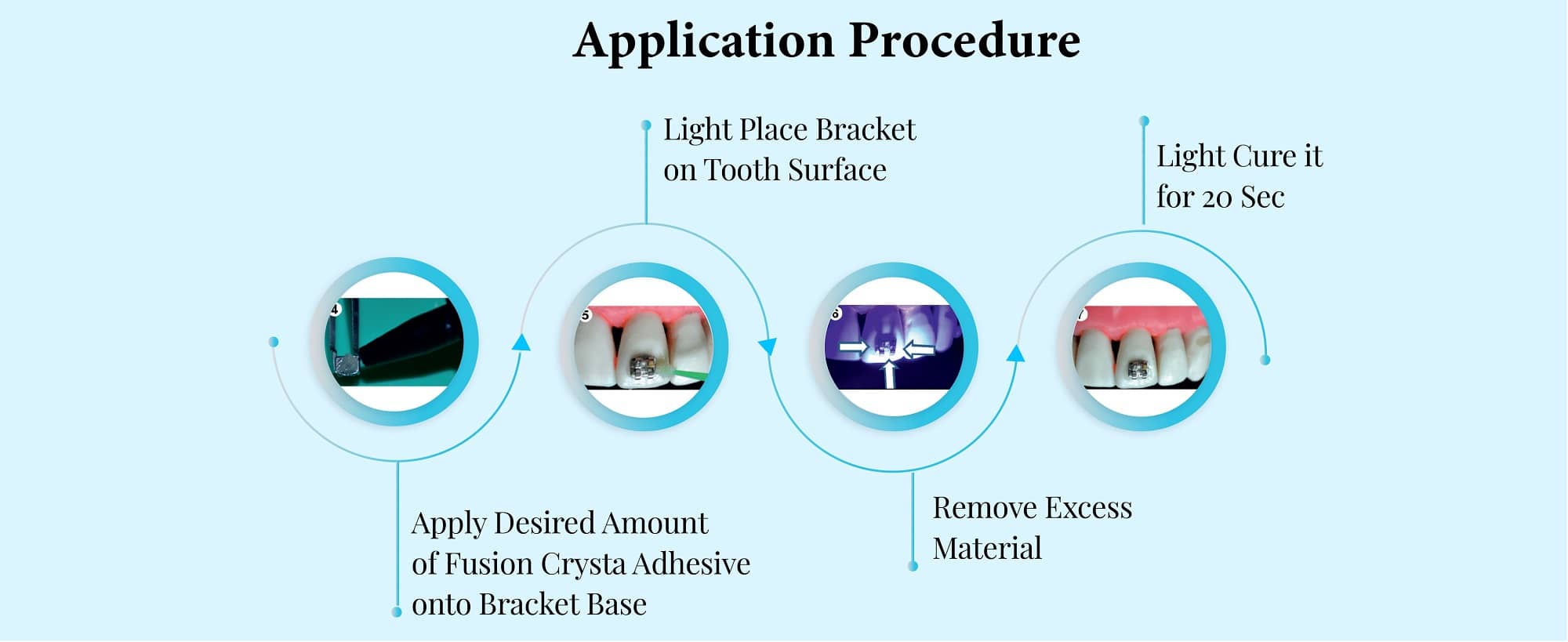 orthodontic adhesive kit