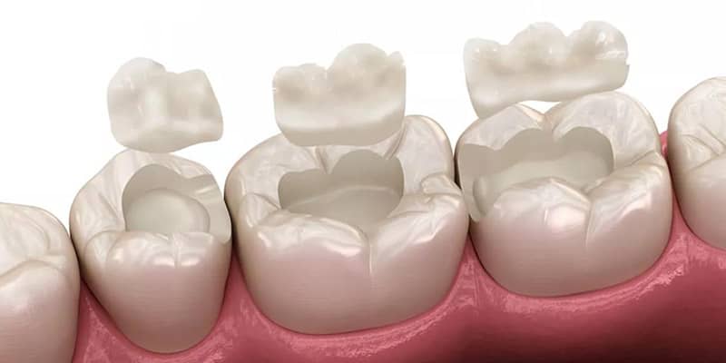 Nano ceramic restorative composite